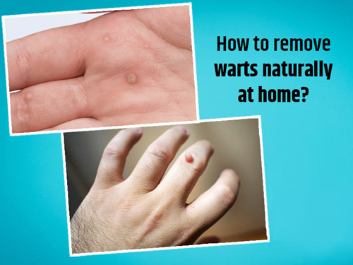 Natural Remedies to Get Rid of Warts मस्से से मुक्ति के कुदरती उपाय