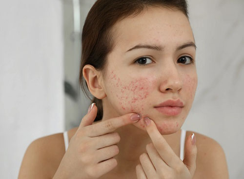 What Should Eat When I Have Acne मुंहासों से छुटकारा पाना चाहते हैं तो डाइट में शामिल करें ये चीजें