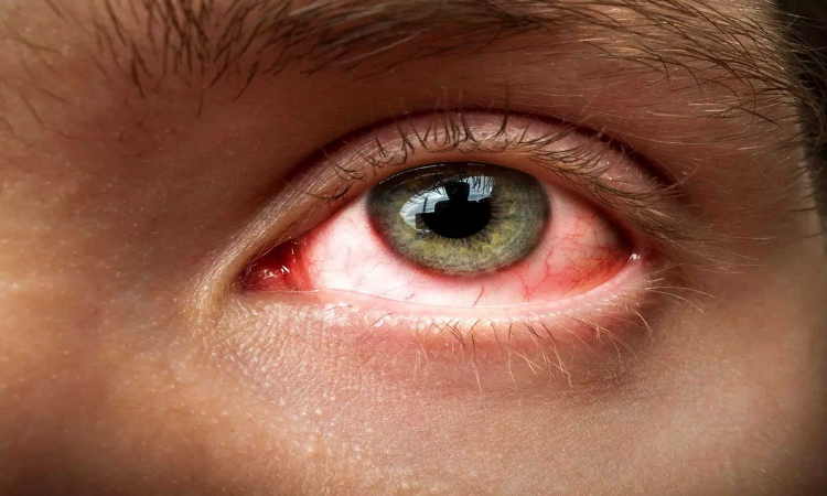 Eye Flu: क्यों फैल रहा है भारत में आई फ्लू का कहर, आपकी इन गलतीयों से आप भी हो सकते है शीकार, जानें बचाव…