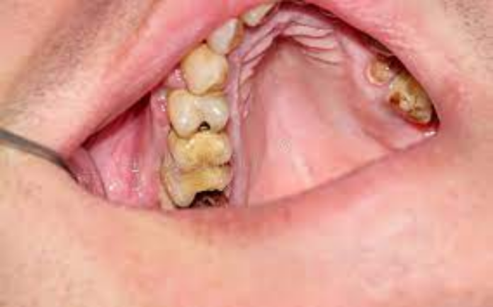 Teeth Cavity: